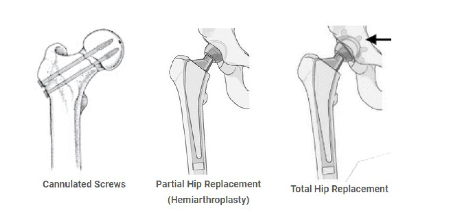Femoral Neck Fracture